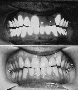 Ultraviolet fluorescence of teeth