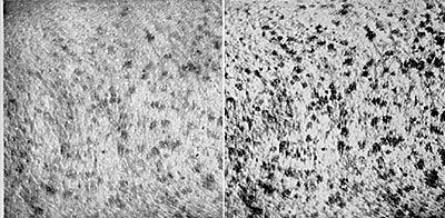 UV transparency of melanin in freckles