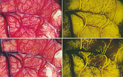 Fluorescein photographs of the brain